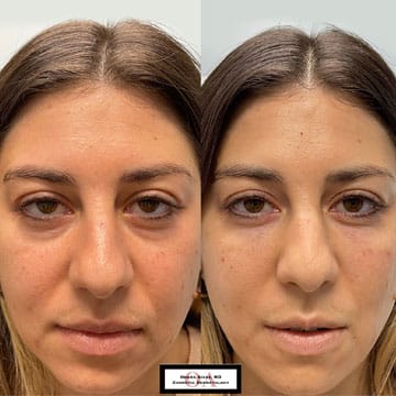 Before and after picture of a patient undergone Under Eye fillers procedure