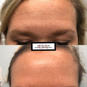 Before and after picture of a patient undergone wrinkle reduction procedure