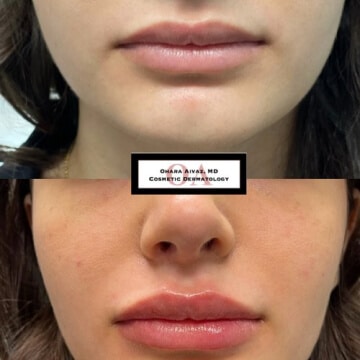 Before and after picture of a patient undergone Lip fillers procedure