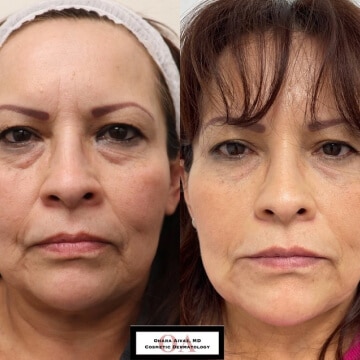 Before and after picture of a patient undergone Facial Rejuvenation procedure