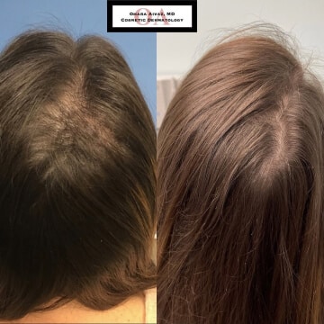 Before and after picture of a patient undergone Hair Growth procedure