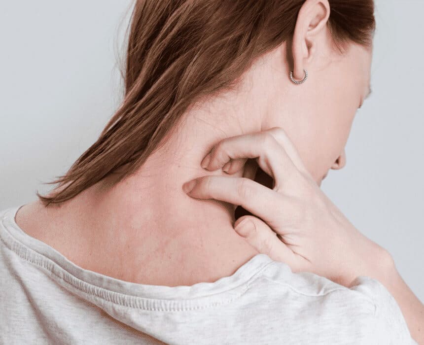 A woman displaying a rash on her neck, highlighting the effects of eczema and the need for effective treatment options.