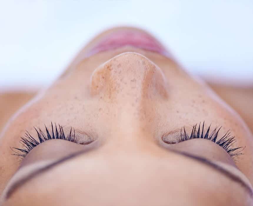 A woman while undergoing melasma treatment.