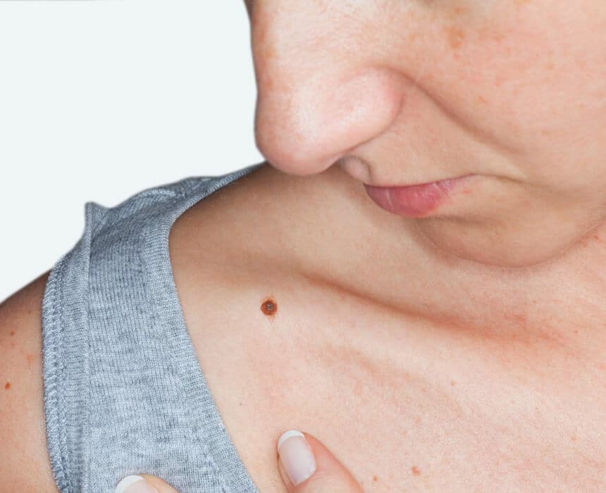 A woman emphasizing the importance of skin tag and mole removal options.